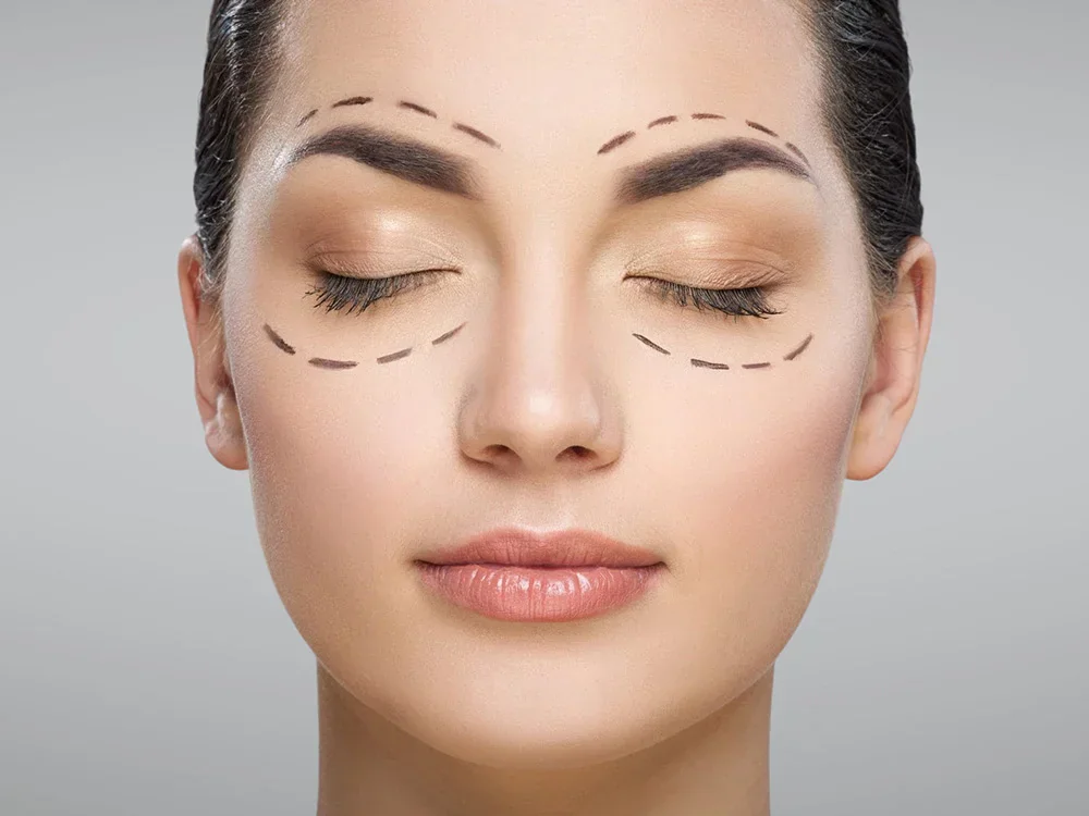 Blefaroplastia